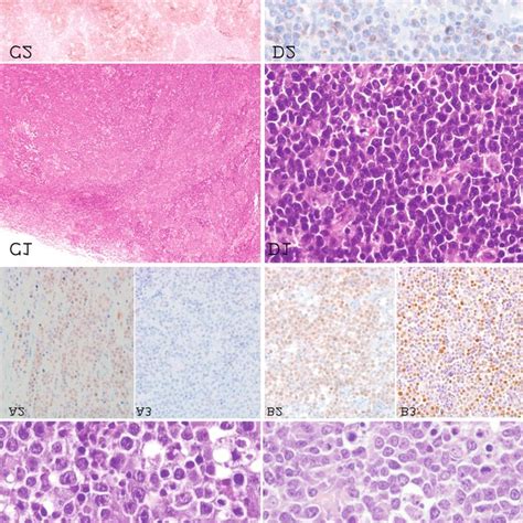 Morphological Features Of Cases Of Burkitt Like Lymphoma With 11q