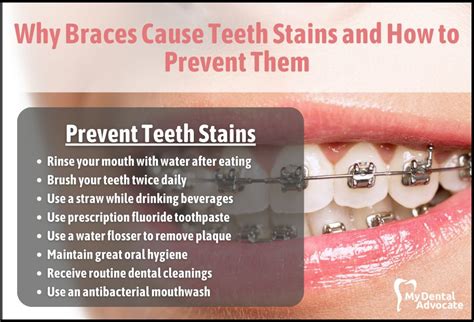 Teeth Staining The Ultimate Guide Content Hub MDA