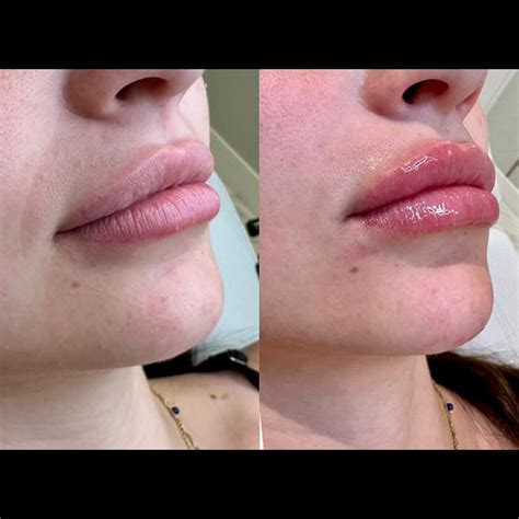 Dermal Fillers San Antonio Tx Cutella Medical Spa