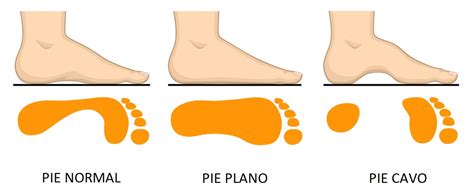 Pies planos en el niño Cómo evoluciona el pie en esta etapa de