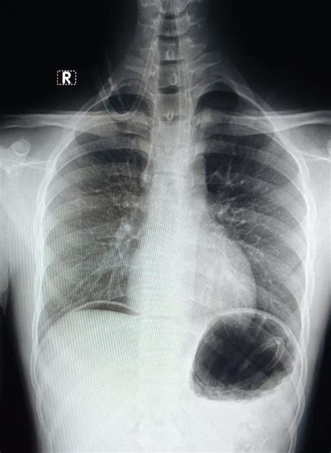 X-ray showing air under domes of diaphragm. | Download Scientific Diagram