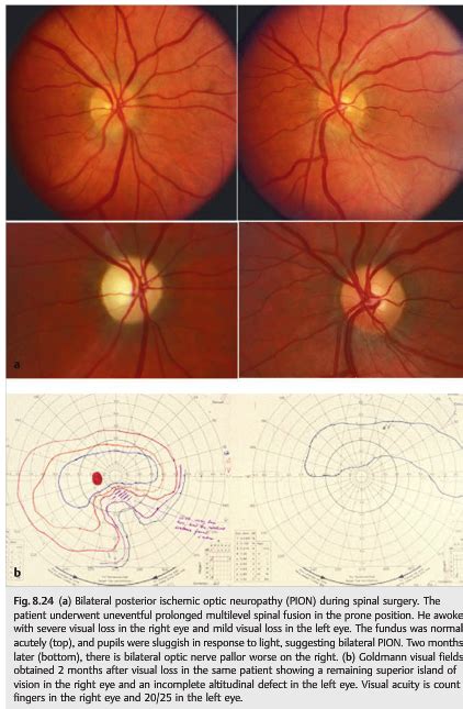 Neuro Ophthalmology Illustrated Chapter Optic Neuropathies