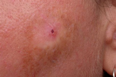 Actinic Keratosis Pictures | Getty Images