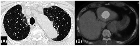 Chest CT taken at the diagnosis of CPFE showed low attenuation areas in... | Download Scientific ...