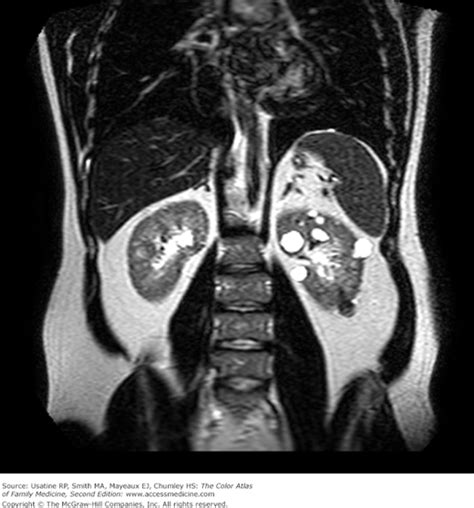 Renal Cell Carcinoma Basicmedical Key