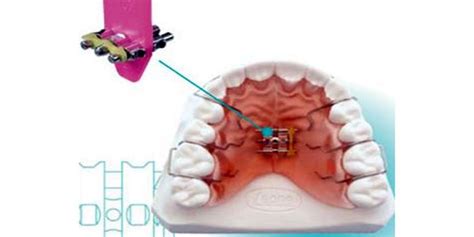 Video Como Activar El Tornillo De Una Placa De Expansi N Odontovida