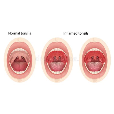 Normal And Inflamed Tonsils Illustration Of A Throat Bacterial And