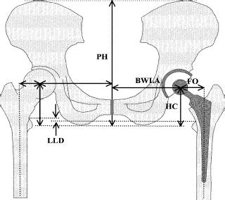 Reconstructed Hip Joint Position And Abductor Muscle Strength After