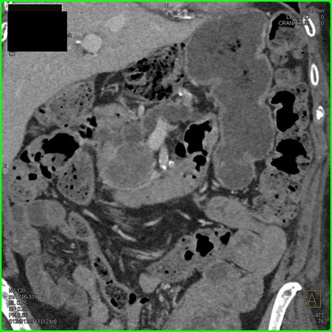 Pancreatic Cancer Invades The Portal Vein Smv And Obstructs The