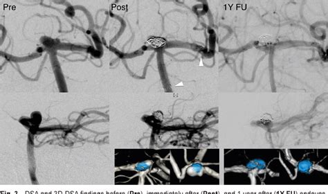 Figure 1 From A Treatment Strategy For Basilar Bifurcation Aneurysm