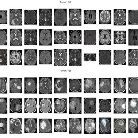 Sample MRI Images for Brain Tumor Detection. | Download Scientific Diagram