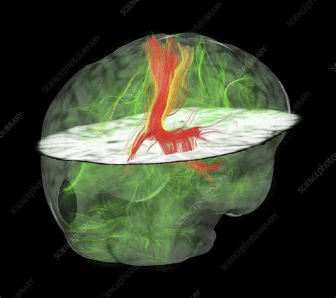 Glioblastoma Brain Tumour Dti Mri Scan Stock Image C