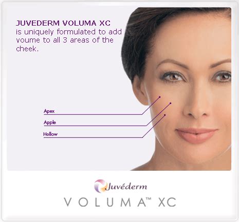 Juvederm Voluma XC - Stefanie A. Mikulics, MD