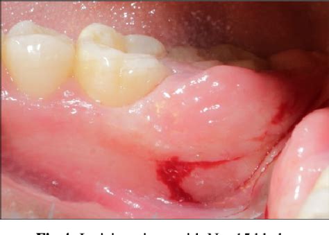 Figure From A Laser Assisted Approach To Treat Fibroepithelial