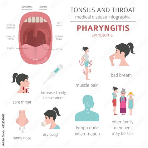 Tonsils and throat diseases. Pharyngitis symptoms, treatment icon set ...