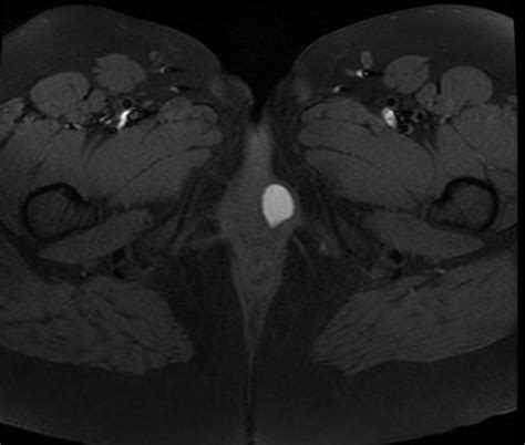 Bartholin's cyst - wikidoc