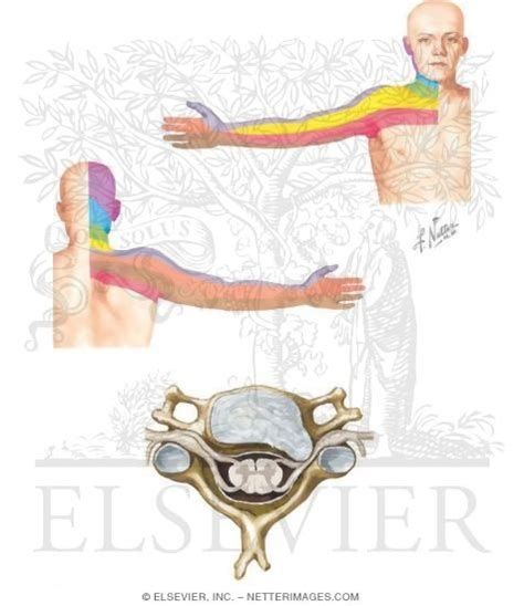 Cervical Radiculopathy Diagram