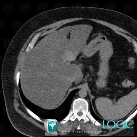 Radiology case : Fatty infiltration (CT) - Diagnologic