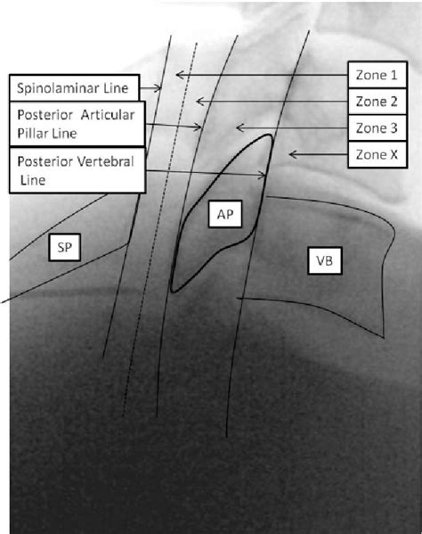 Figure 3 From Cervical Epidural Contrast Spread Patterns In