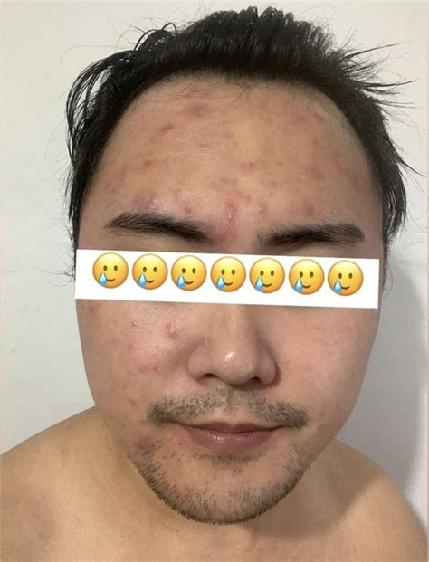 Benzoyl Peroxide saved my skin! : r/acne