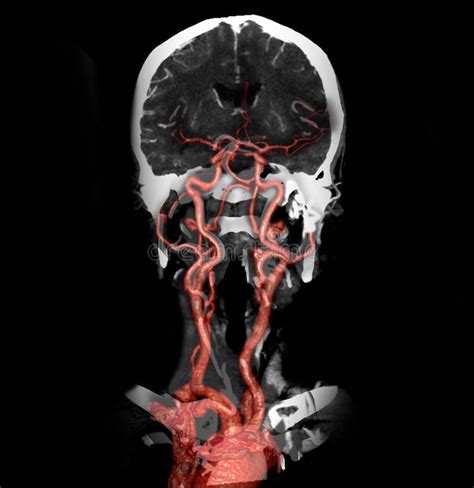 Multi Vista 2d E Imagem Da Rendição 3d Da Angiografia Do Ct Ilustração