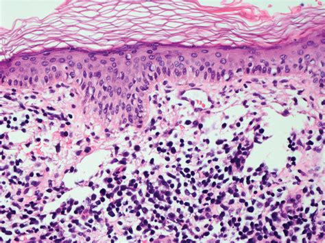 Rapid Onset Of Widespread Nodules And Lymphadenopathy MDedge Dermatology