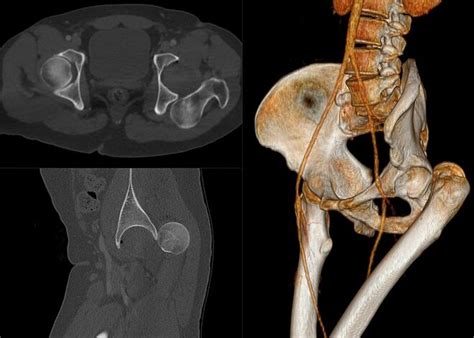 Hip Dislocation - Physiopedia