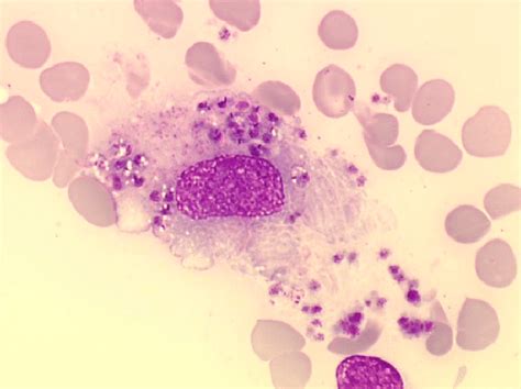 Intrahistiocytic Amastigote Forms Of Leishmania On A Bone Marrow