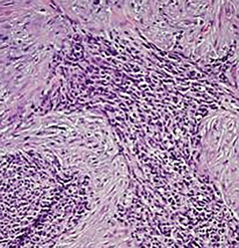 Desmoplastic Small Round Cell Tumor Imaging Pattern Of Disease At