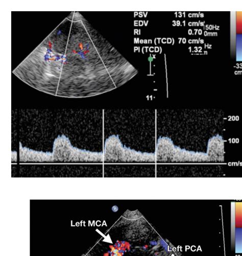 Advances In Transcranial Doppler Us Imaging Ahead Semantic Scholar