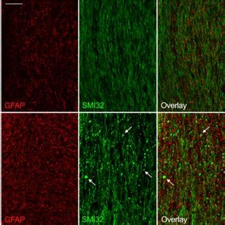 Astroglial Reactivity And Axonal Damage In The Mouse Optic Nerve At The