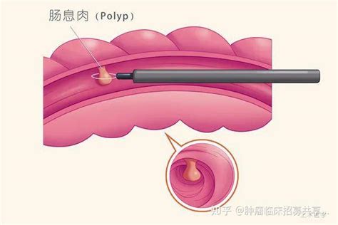 我叫“息肉”，很容易变成癌！ 知乎