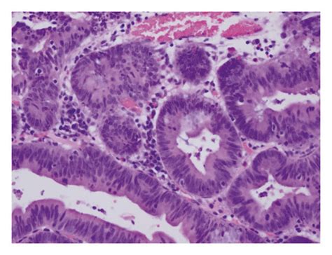 Histological Examination Of Ampullary Mass In Case A Histological