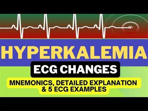 ECG Changes In Hyperkalemia Easy Mnemonic Simple Explanation YouTube