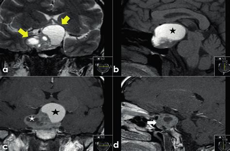 Pituitary adenoma in a 34-year-old female patient with a superior ...