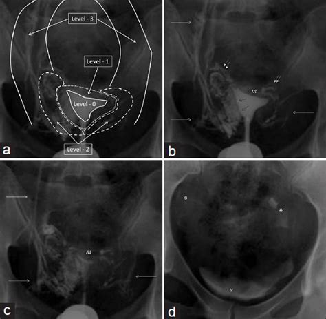 Venous Intravasation As A Complication And Potential Pitfall During