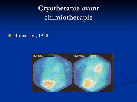 Ppt Cryotherapie Dans Le Cancer Bronchique Powerpoint Presentation