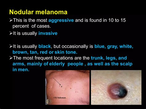 Melanoma And Melanoma Types With Treatment Ppt