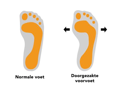 Spreidvoet Informatie Oorzaken Een Passende Behandeling Hot Sex Picture