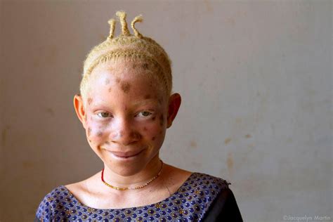 Where Albinism Means Being Targeted For Murder Or Dismemberment