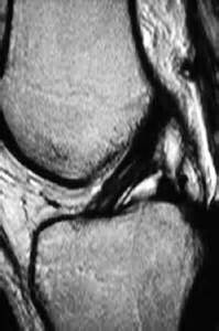 Radiologia Do Esporte Entorse De Joelho Em Praticante De Gin Stica