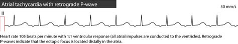 Atrial Tachycardia Ecg