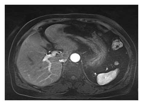 Mr Images Obtained In A 68 Year Old Woman For Workup Of Metastasis Download Scientific Diagram