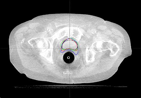 Figure From Planning Of Radiotherapy On Cone Beam Computerized