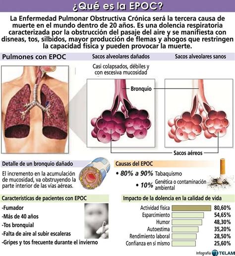 La Enfermedad Pulmonar Obstructiva Cr Nica O Epoc Es Una De Las