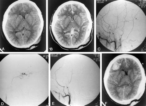 Case 7 A Ct Scan Demonstrates An Epidural Hematoma On The Left Side