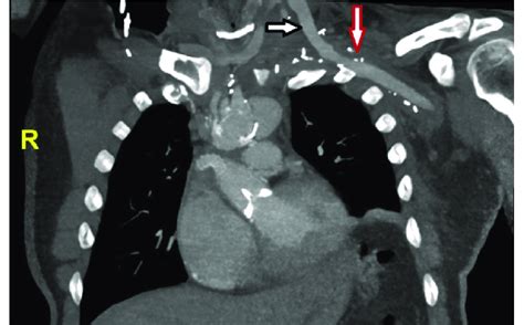 Postoperative Ct Scan Carotid Subclavian Artery Bypass Using Femoral Download Scientific