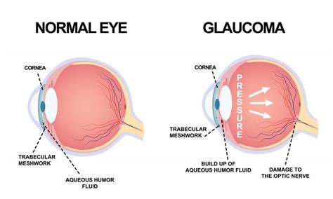 Glaucoma Signs And Treatment Neo Eye Clinic