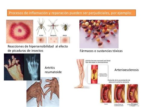 Inflamacion Aguda Y Cronica