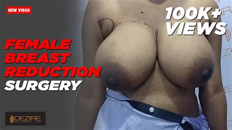 Female Scarless Breast Reduction Dr Prashant Dezire Clinic India